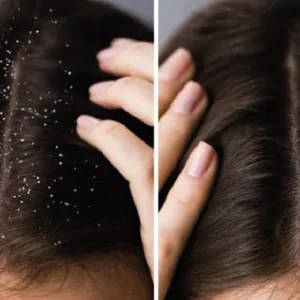 Dandruff Treatment
