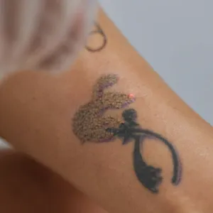 Tattoo Removal Treatment