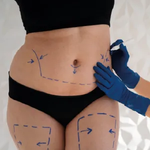 Liposuction Surgery