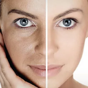 Fillers Treatment