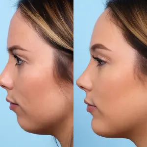 Chin Implant Surgery